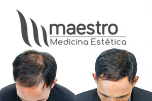 Clinica estetica maestro. Hombre antes y despues de calvicie