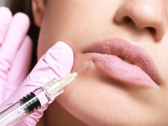 bajar hinchazon de ácido hialurónico labios